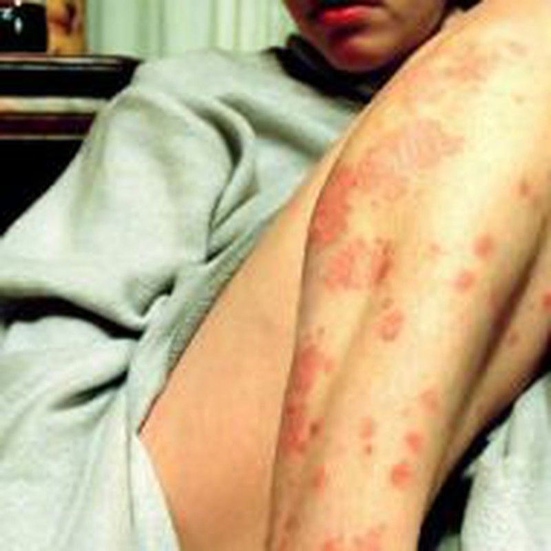 Cómo aliviar la psoriasis de manera natural