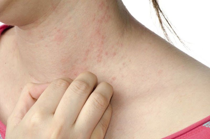 ¿Sabes cómo tratar las pieles atópicas?