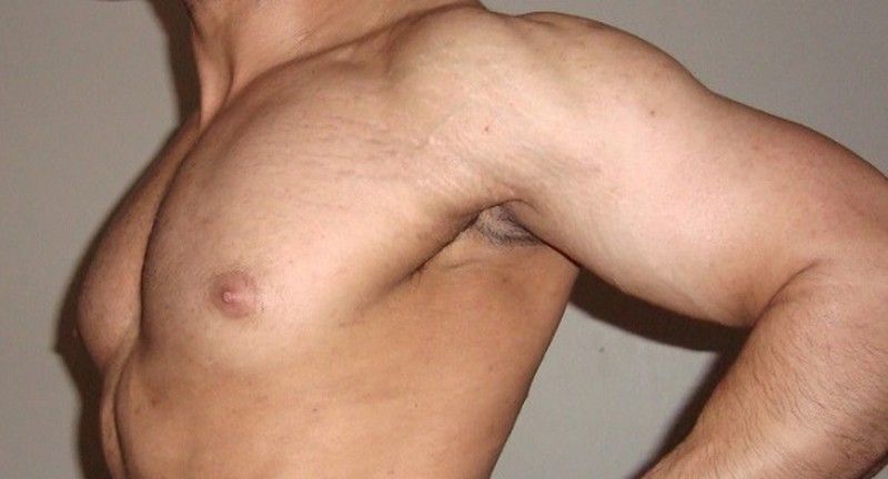 Antiestrías para proteger la piel