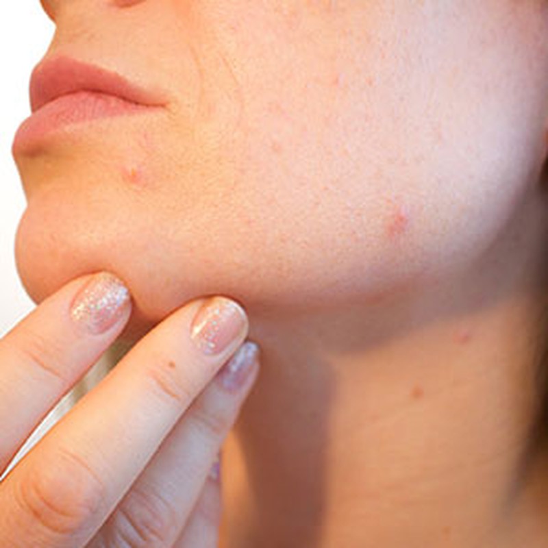 El acné, la enfermedad de la piel más común