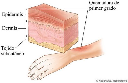 Cuidados y remedios para hacer frente a una quemadura  hacer frente a una quemadura